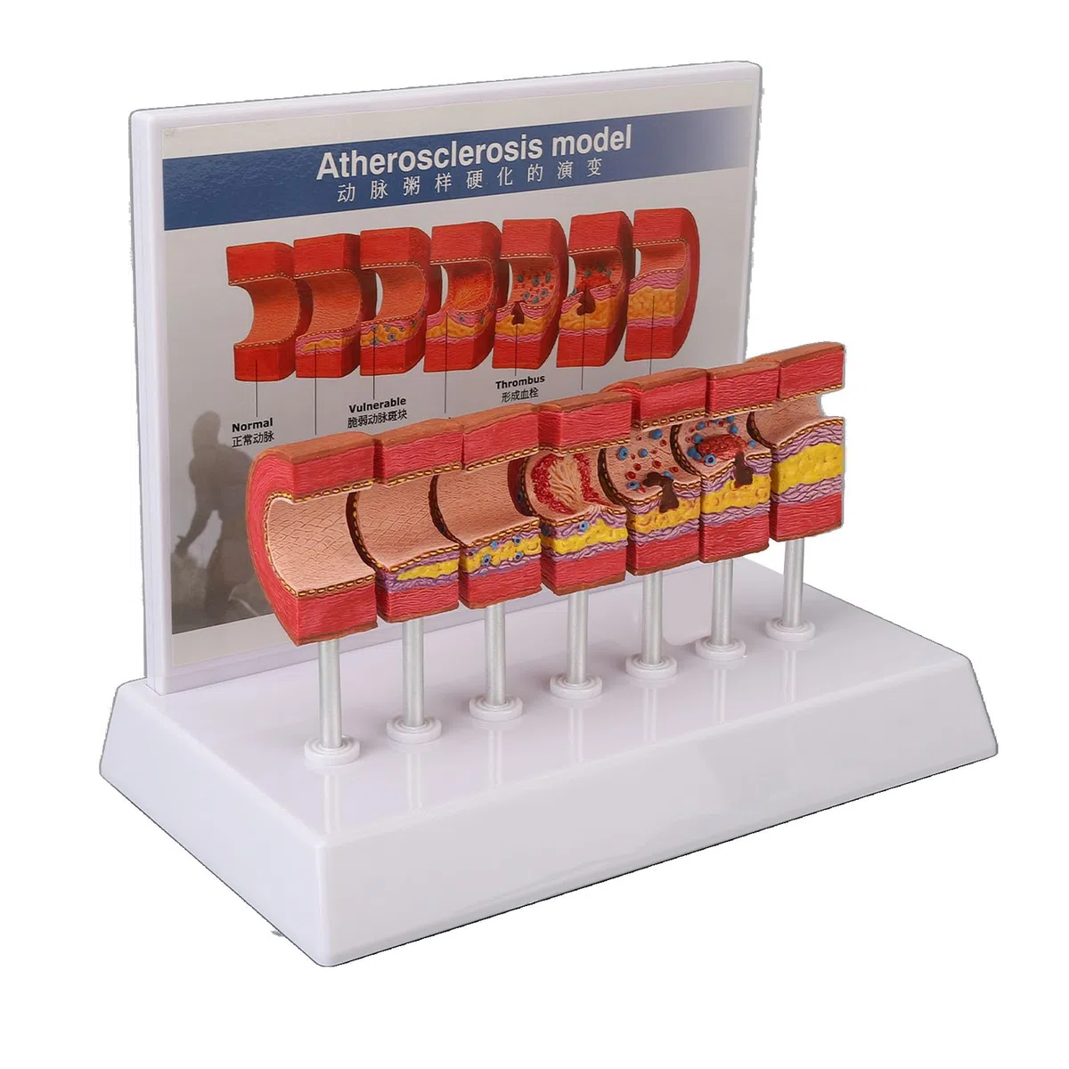 Modello anatomico di arteria - Modello anatomico di aterosclerosi aterosolare del Vaso Modello di Anatomia dell'arteria Umana - per la visualizzazione dello Studio Insegnamento del Modello Medic